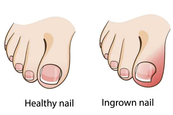 Ingrown Toe Nail Surgery - Aura Plastic Surgery