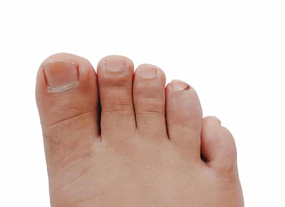 ingrown-nail-onychocryptosis-on-white-background_