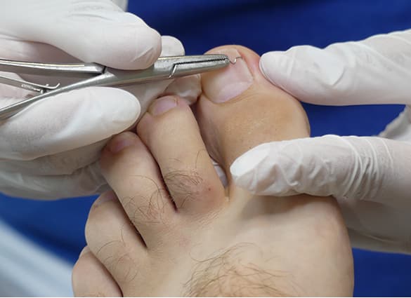 ingrown-toenail-bracing-4