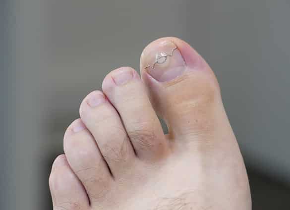 ingrown-toenail-bracing-7