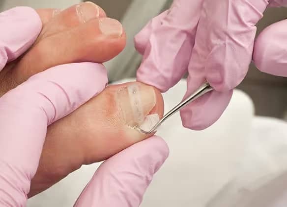 Best Ingrown Toenail Surgery in Delhi | Toenail Treatment Cost in Vasant  Vihar, India