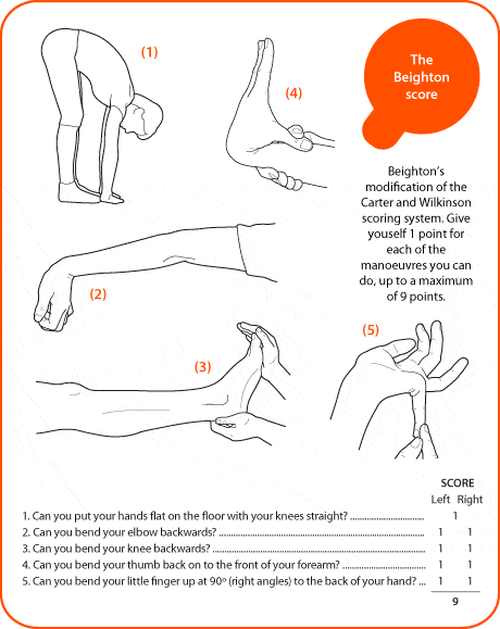 joint-hypermobility