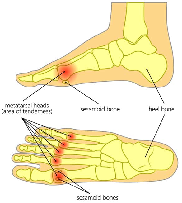 metatarsalgia-symptom