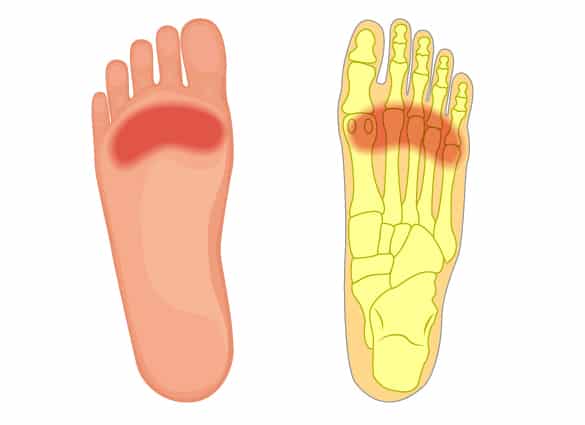 metatarsalgia-symptoms