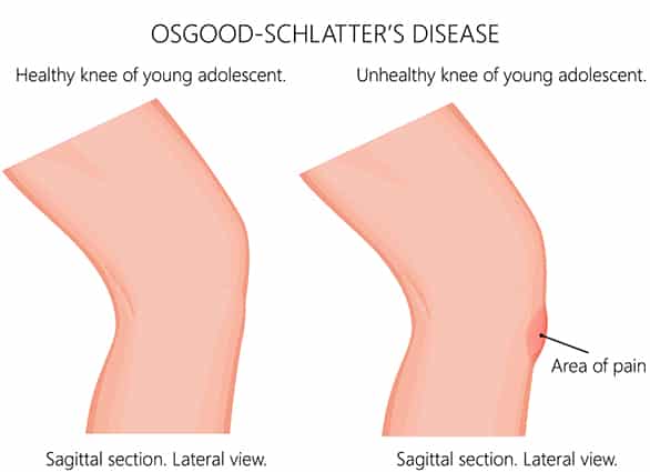 osgood-schlatter-disease-infographic-1