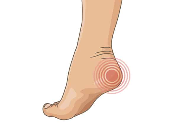 Severs Disease | Foot Health Clinic 