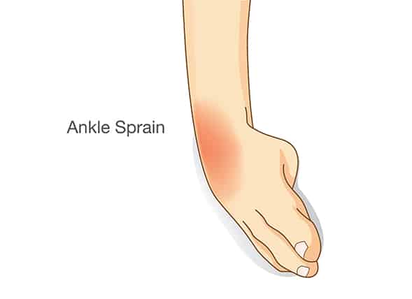 sprain-ankle-post-4