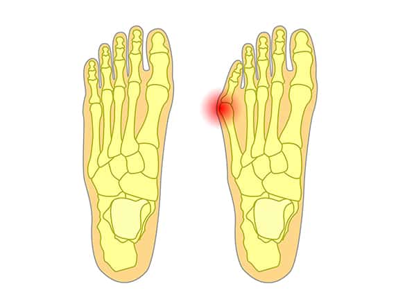 tailors-bunion-graphic