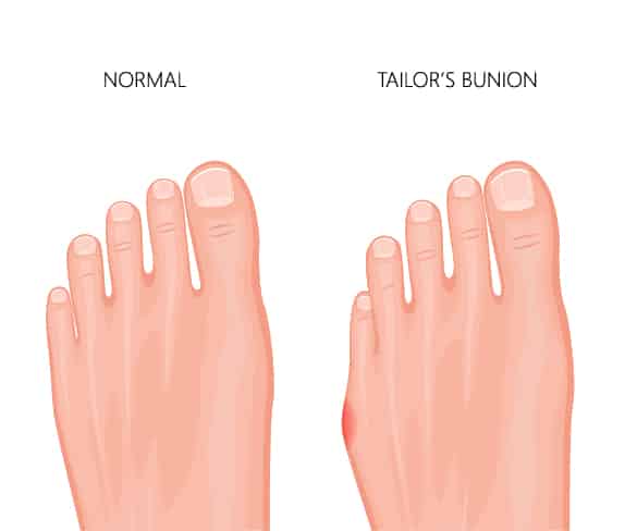Tailor S Bunion Foot Health Clinic Samford Village Qld Tailor S Bunion Foot Health Clinic Samford Village Qld