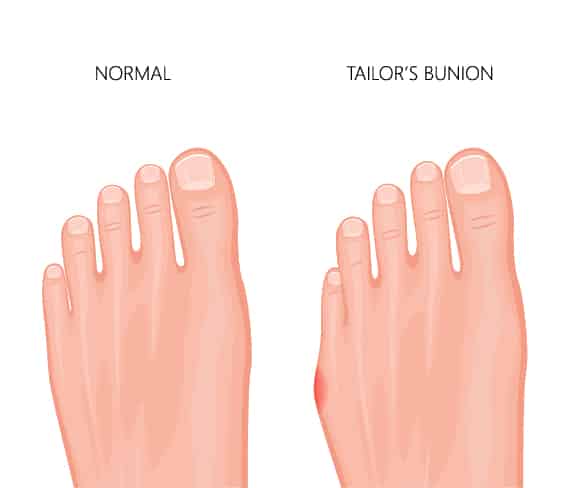 tailors-bunion