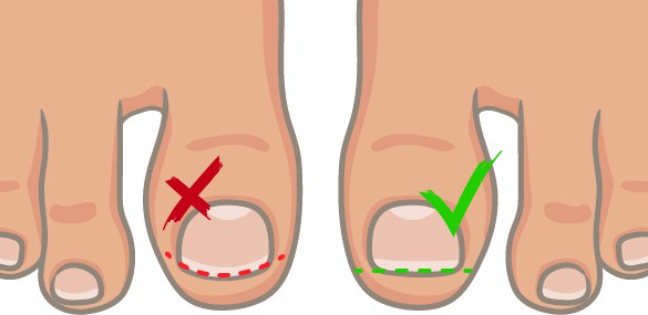 toenails-cutting-infographic