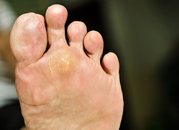 wart-under-foot-can-treatment-by-salicylic-acid_