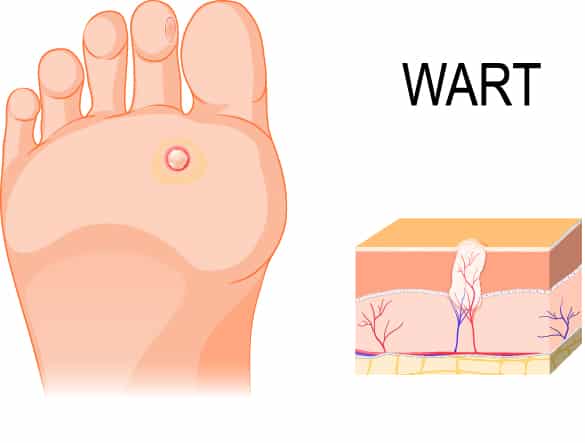 wart