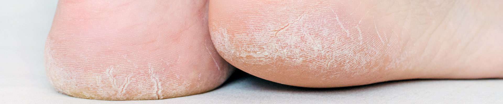 womans-feet-with-dry-heels-cracked-skin
